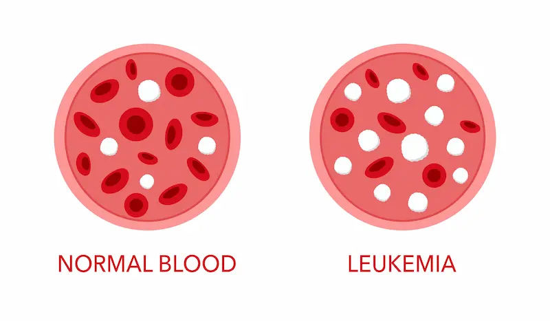 Chronic Lymphocytic Leukaemia (CCL) Overview and Management